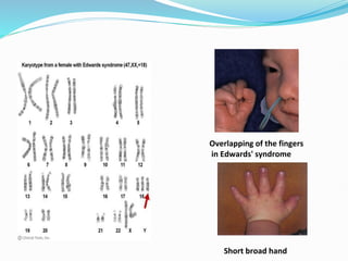 Overlapping of the fingers
in Edwards' syndrome
Short broad hand
 