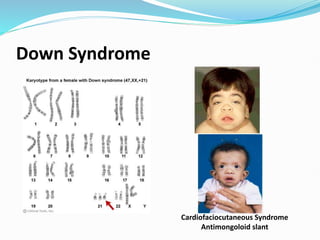 Down Syndrome
Cardiofaciocutaneous Syndrome
Antimongoloid slant
 
