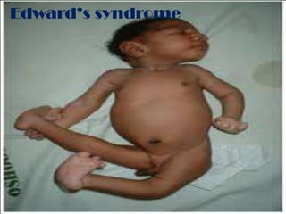 Edward’s syndrome
 