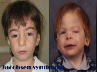 Jacobsen syndrome
 