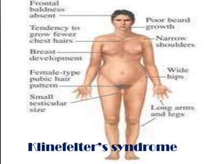 Klinefelter’s syndrome
 