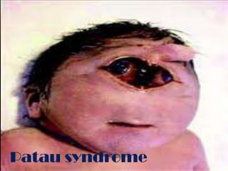 Patau syndrome
 
