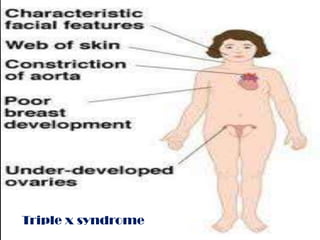 Triple x syndrome
 
