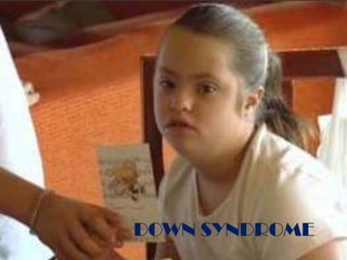 DOWN SYNDROME
 