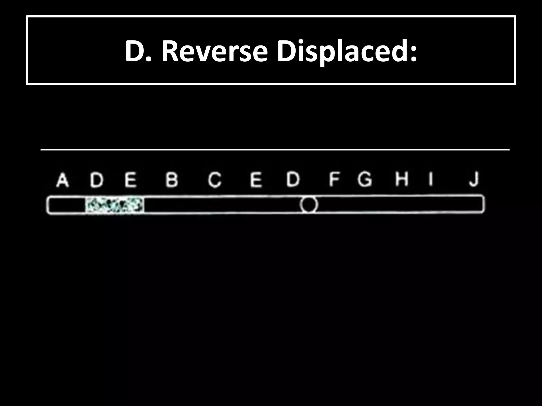 D. Reverse Displaced:
 