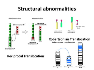 Structural abnormalities
Reciprocal Translocation
Robertsonian Translocation
 