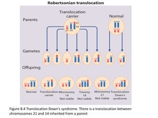 Figure 8.4 Translocation Down's syndrome. There is a translocation between
chromosomes 21 and 14 inherited from a parent
 