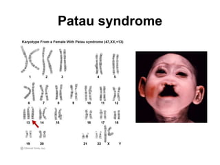 Patau syndrome
 
