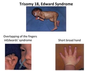 Trisomy 18, Edward Syndrome
Overlapping of the fingers
inEdwards' syndrome Short broad hand
 