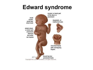 Edward syndrome
 