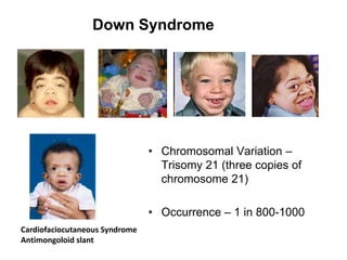 Down Syndrome
Cardiofaciocutaneous Syndrome
Antimongoloid slant
• Chromosomal Variation –
Trisomy 21 (three copies of
chromosome 21)
• Occurrence – 1 in 800-1000
 