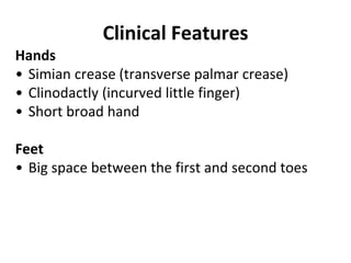 Hands
• Simian crease (transverse palmar crease)
• Clinodactly (incurved little finger)
• Short broad hand
Feet
• Big space between the first and second toes
Clinical Features
 