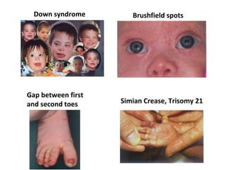 Down syndrome Brushfield spots
Simian Crease, Trisomy 21
Gap between first
and second toes
 