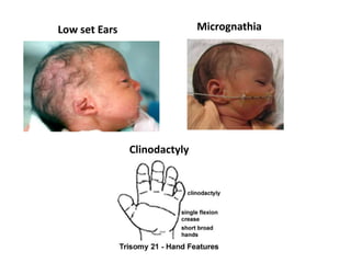 Low set Ears Micrognathia
Clinodactyly
 
