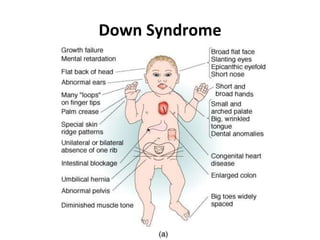 Down Syndrome
 