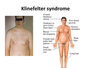 Klinefelter syndrome
 