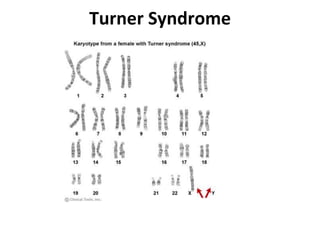 Turner Syndrome
 