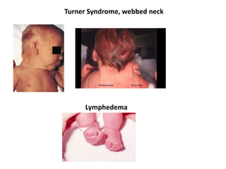 Turner Syndrome, webbed neck
Lymphedema
 
