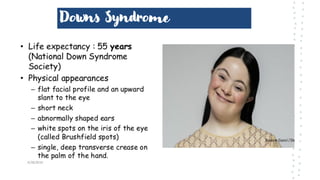 Downs Syndrome
 