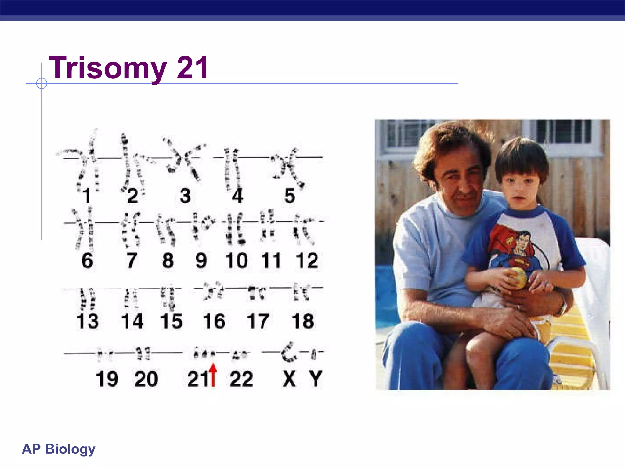 Trisomy 21 