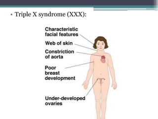 • Triple X syndrome (XXX):
 