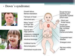 • Down´s syndrome:
 