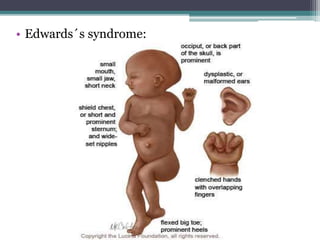 • Edwards´s syndrome:
 