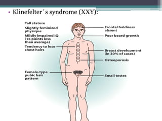 • Klinefelter´s syndrome (XXY):
 