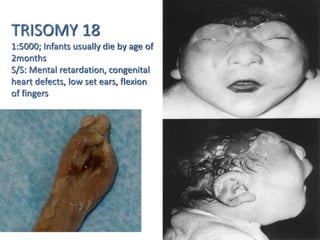 TRISOMY 18
1:5000; Infants usually die by age of
2months
S/S: Mental retardation, congenital
heart defects, low set ears, flexion
of fingers
 