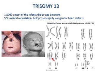 TRISOMY 13
1:5000 ; most of the infants die by age 3months
S/S: mental retardation, holoprosencephly, congenital heart defects
 