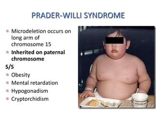 PRADER-WILLI SYNDROME
Microdeletion occurs on
long arm of
chromosome 15
Inherited on paternal
chromosome
S/S
Obesity
Mental retardation
Hypogonadism
Cryptorchidism
 