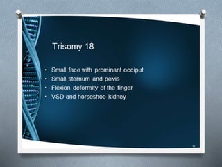 Trisomy-18
 