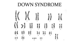 DOWN SYNDROME
 