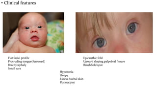 • Clinical features
Flat facial profile
Protruding tongue(furrowed)
Brachycephaly
Small ears
Epicanthic fold
Upward sloping palpebral fissure
Brushfield spot
Hypotonia
Sleepy
Excess nuchal skin
Flat occiput
 