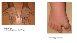 Sandal gap deformity
Simian crease
Small middle phalanx of 5th finger
 