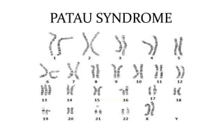 PATAU SYNDROME
 