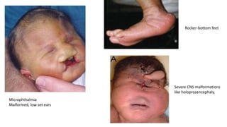 Rocker-bottom feet
Microphthalmia
Malformed, low set ears
Severe CNS malformations
like holoprosencephaly.
 