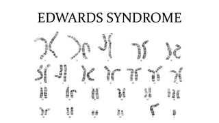 EDWARDS SYNDROME
 