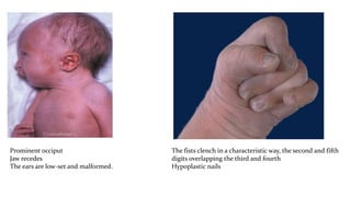 Prominent occiput
Jaw recedes
The ears are low-set and malformed.
The fists clench in a characteristic way, the second and fifth
digits overlapping the third and fourth
Hypoplastic nails
 