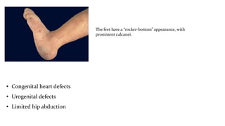 The feet have a “rocker-bottom” appearance, with
prominent calcanei.
• Congenital heart defects
• Urogenital defects
• Limited hip abduction
 