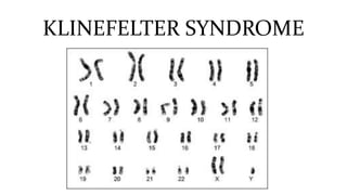 KLINEFELTER SYNDROME
 