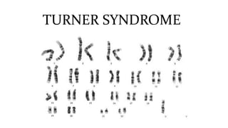 TURNER SYNDROME
 