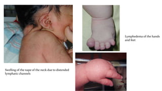 Swelling of the nape of the neck due to distended
lymphatic channels
Lymphedema of the hands
and feet
 
