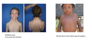 Webbed neck
Low posterior hairline
Broad chest with widely spaced nipples
 