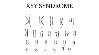 XYY SYNDROME
 