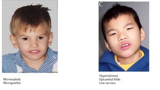 Microcephaly
Micrognathia
Hypertelorism
Epicanthal folds
Low-set ears
 