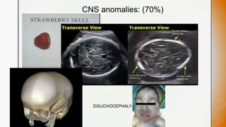 z
CNS anomalies: (70%)
DOLICHOCEPHALY
 