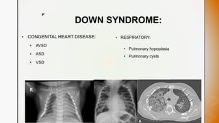 z
DOWN SYNDROME:
 CONGENITAL HEART DISEASE:
 AVSD
 ASD
 VSD
• RESPIRATORY:
• Pulmonary hypoplasia
• Pulmonary cysts
 