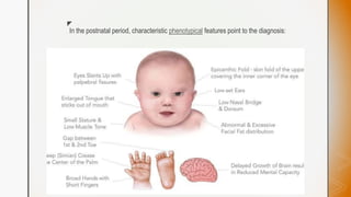 z
In the postnatal period, characteristic phenotypical features point to the diagnosis:
 