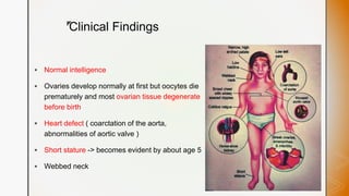 z
Clinical Findings
 Normal intelligence
 Ovaries develop normally at first but oocytes die
prematurely and most ovarian tissue degenerate
before birth
 Heart defect ( coarctation of the aorta,
abnormalities of aortic valve )
 Short stature -> becomes evident by about age 5
 Webbed neck
 